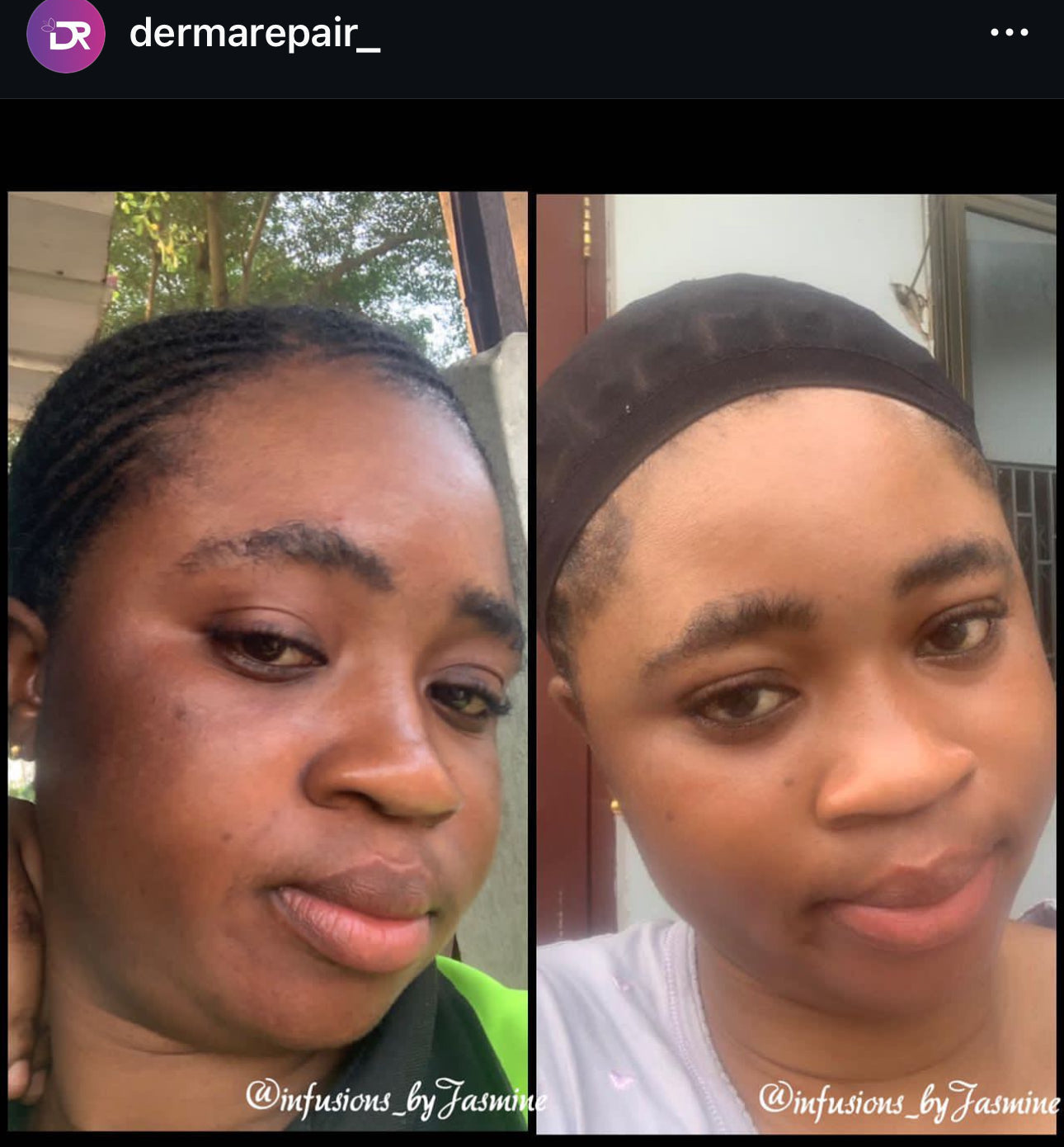 Why Dermarepair Skincare is Your Go-To for Natural Solutions to Oily Skin and Hyperpigmentation